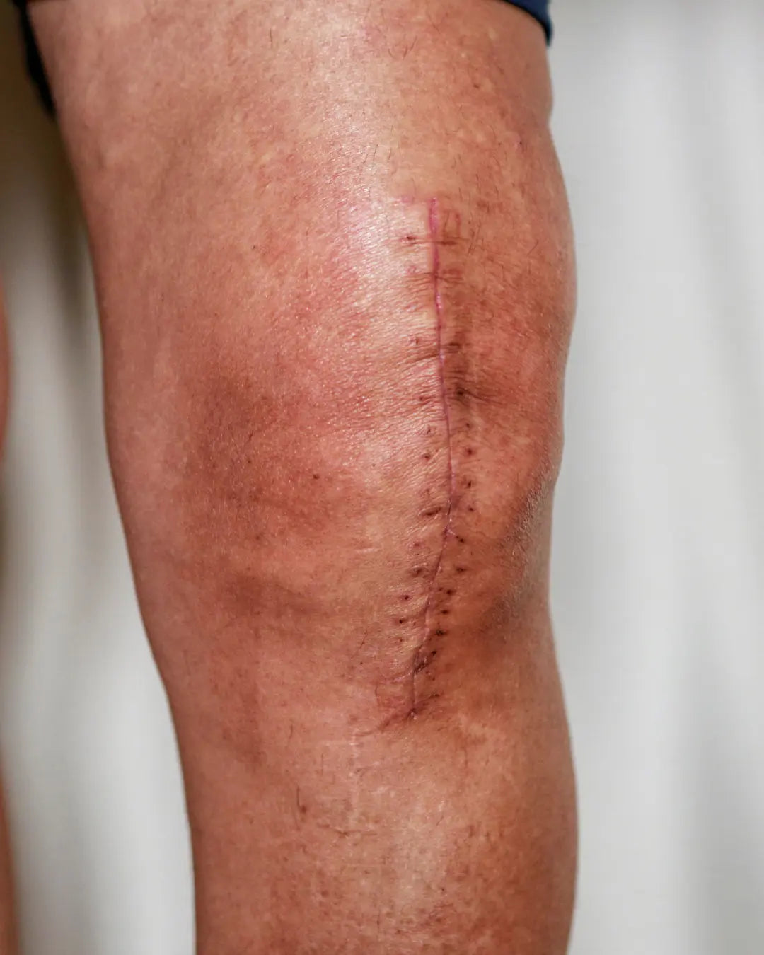 knee with a stitched scar
